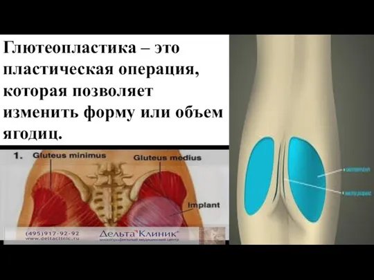 Глютеопластика – это пластическая операция, которая позволяет изменить форму или объем ягодиц.