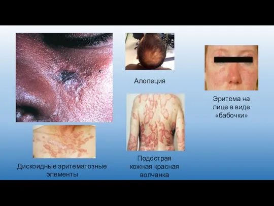 Дискоидные эритематозные элементы Алопеция Подострая кожная красная волчанка Эритема на лице в виде «бабочки»