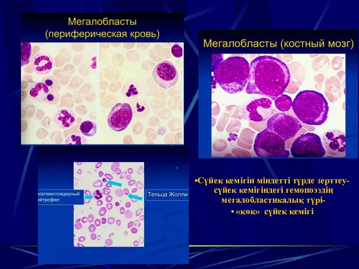 Сүйек кемігін міндетті түрде зерттеу-сүйек кемігіндегі гемопоэздің мегалобластикалық түрі- «көк» сүйек кемігі