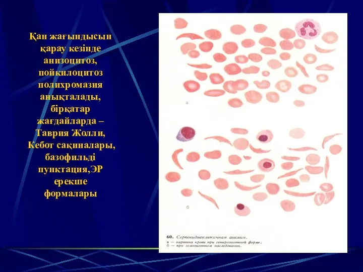 Қан жағындысын қарау кезінде анизоцитоз, пойкилоцитоз полихромазия анықталады, бірқатар жағдайларда –Таврия