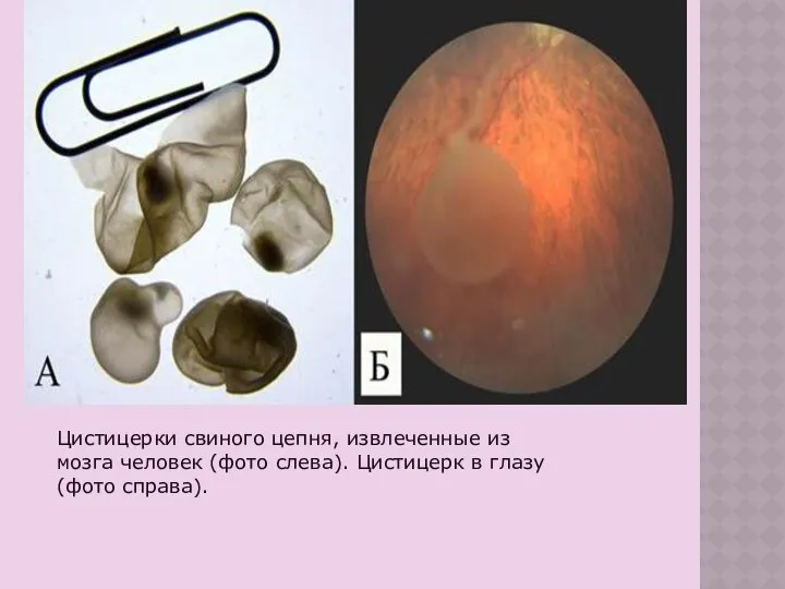 Цистицерки свиного цепня, извлеченные из мозга человек (фото слева). Цистицерк в глазу (фото справа).