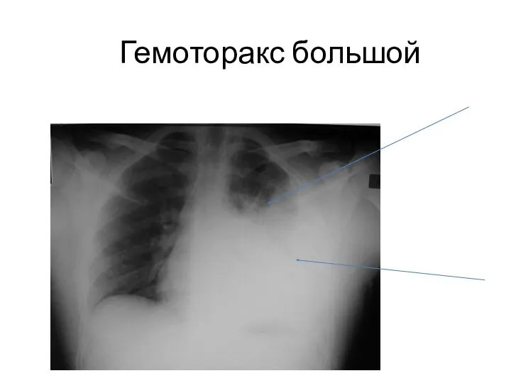 Гемоторакс большой