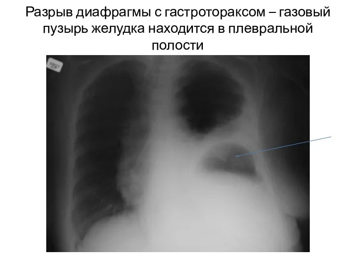 Разрыв диафрагмы с гастротораксом – газовый пузырь желудка находится в плевральной полости