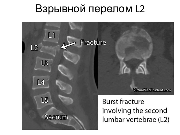 Взрывной перелом L2