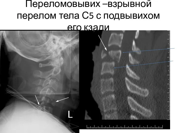 Переломовывих –взрывной перелом тела С5 с подвывихом его кзади