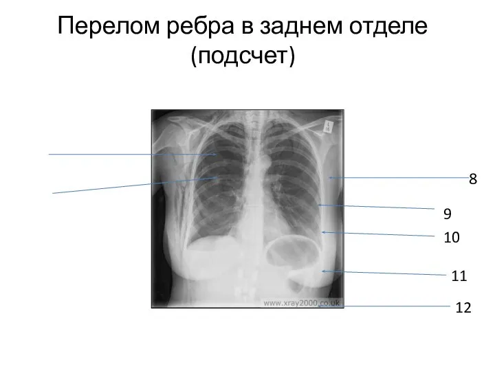 Перелом ребра в заднем отделе (подсчет) 8 9 10 11 12