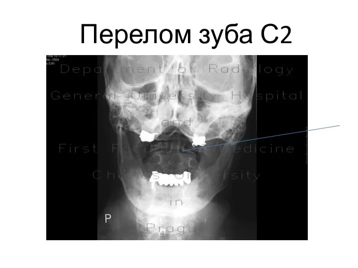 Перелом зуба С2