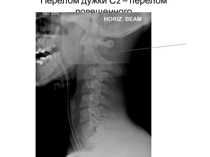 Перелом дужки С2 – перелом повешенного