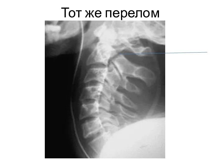 Тот же перелом