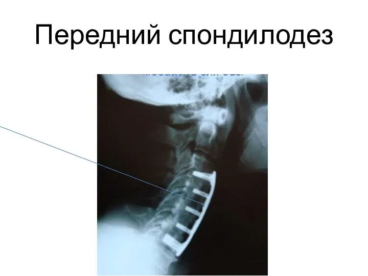 Передний спондилодез