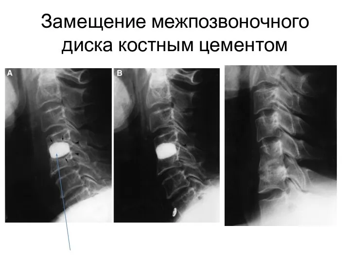 Замещение межпозвоночного диска костным цементом