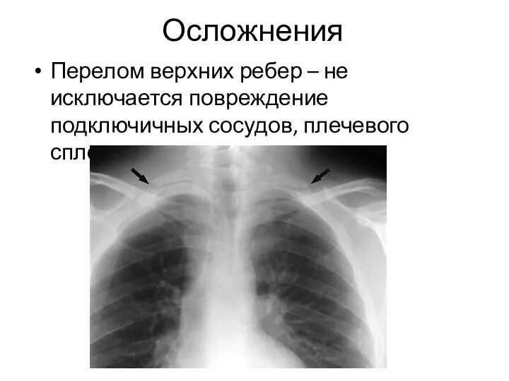 Осложнения Перелом верхних ребер – не исключается повреждение подключичных сосудов, плечевого сплетения