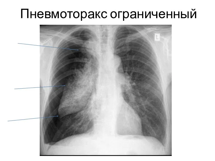 Пневмоторакс ограниченный