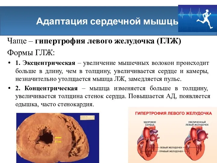 Чаще – гипертрофия левого желудочка (ГЛЖ) Формы ГЛЖ: 1. Эксцентрическая –