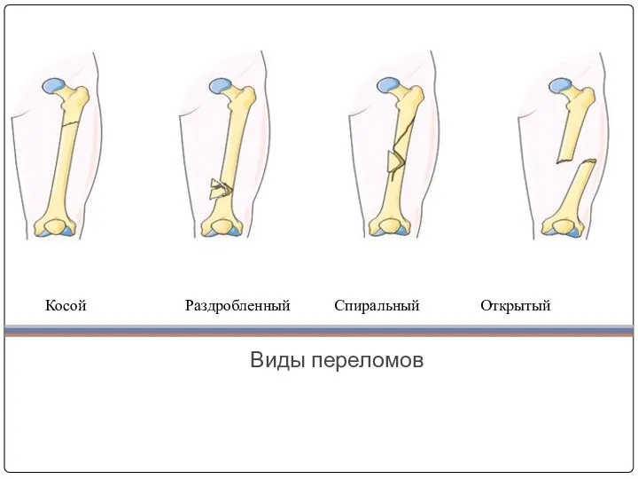 Виды переломов Косой Раздробленный Спиральный Открытый