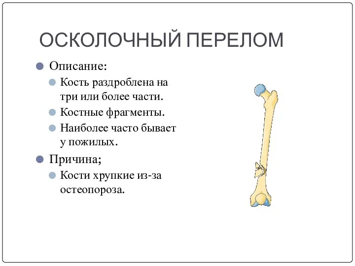 ОСКОЛОЧНЫЙ ПЕРЕЛОМ Описание: Кость раздроблена на три или более части. Костные