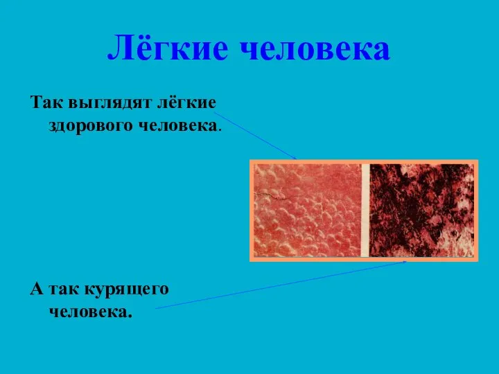 Лёгкие человека Так выглядят лёгкие здорового человека. А так курящего человека.