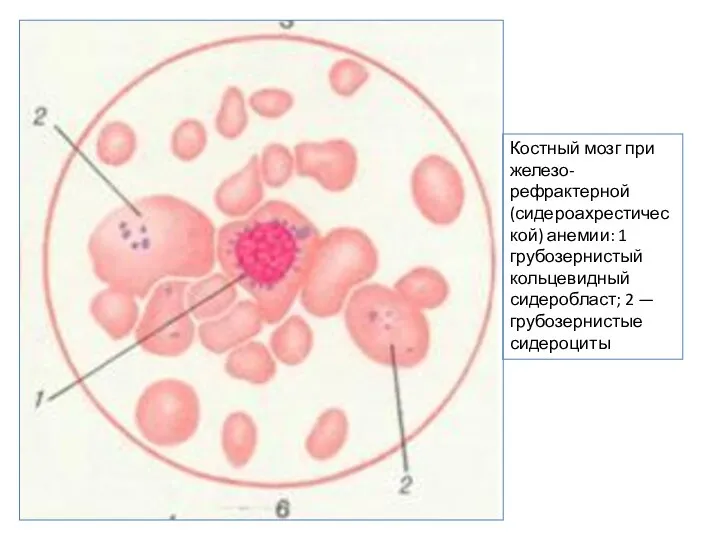 Костный мозг при железо-рефрактерной (сидероахрестической) анемии: 1 грубозернистый кольцевидный сидеробласт; 2 — грубозернистые сидероциты