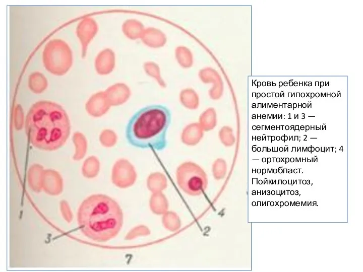 Кровь ребенка при простой гипохромной алиментарной анемии: 1 и 3 —