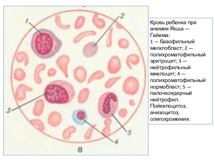 Кровь ребенка при анемии Якша — Гайема: 1 — базофильный мегалобласт;