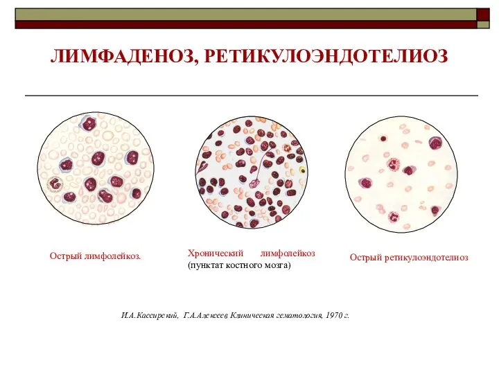 ЛИМФАДЕНОЗ, РЕТИКУЛОЭНДОТЕЛИОЗ Хронический лимфолейкоз (пунктат костного мозга) Острый лимфолейкоз. Острый ретикулоэндотелиоз