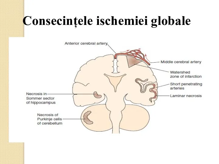 Consecințele ischemiei globale