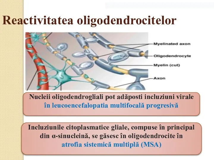 Reactivitatea oligodendrocitelor Nucleii oligodendrogliali pot adăposti incluziuni virale în leucoencefalopatia multifocală