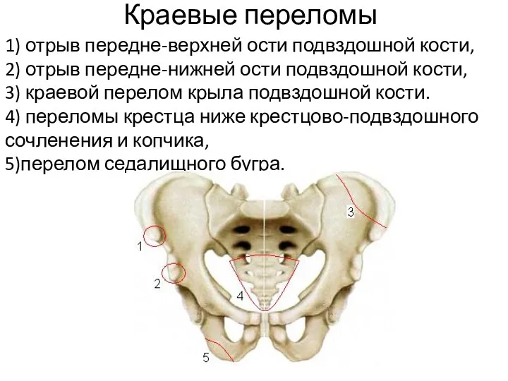 Краевые переломы 1) отрыв передне-верхней ости подвздошной кости, 2) отрыв передне-нижней