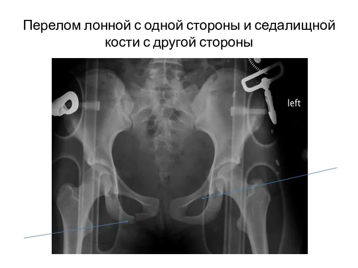 Перелом лонной с одной стороны и седалищной кости с другой стороны