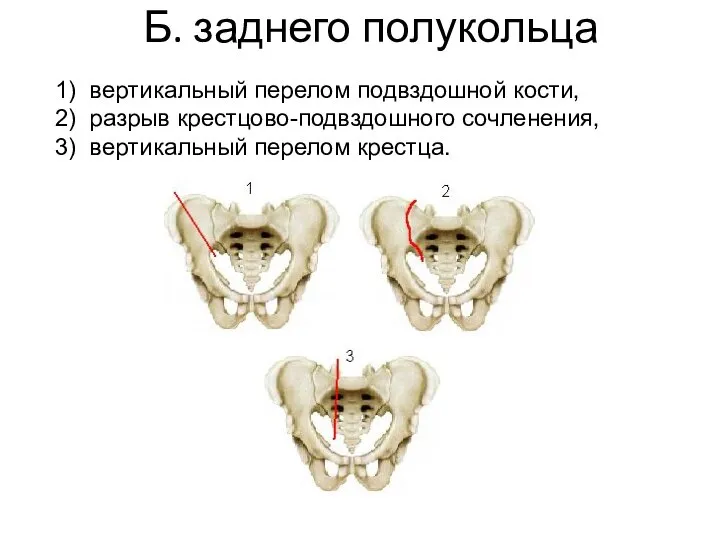 Б. заднего полукольца 1) вертикальный перелом подвздошной кости, 2) разрыв крестцово-подвздошного сочленения, 3) вертикальный перелом крестца.