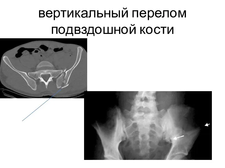 вертикальный перелом подвздошной кости