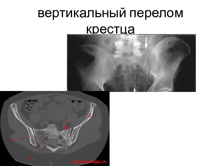 вертикальный перелом крестца