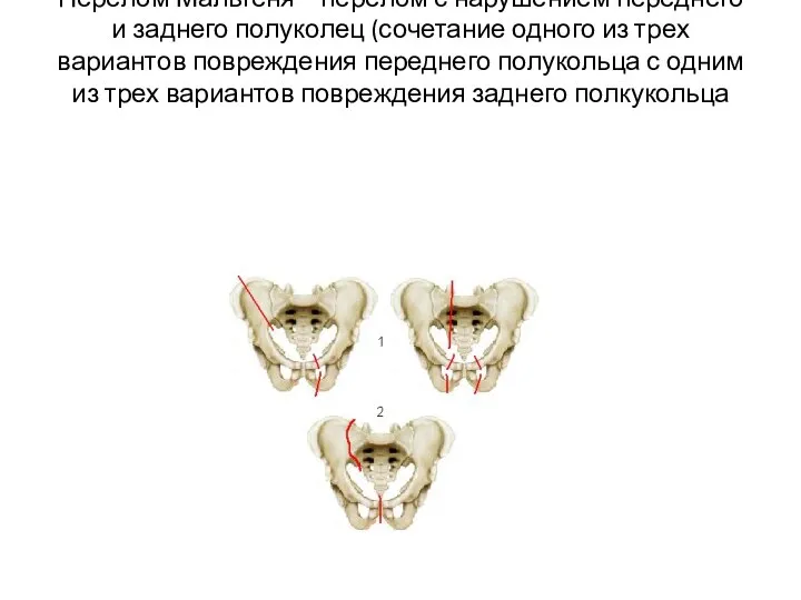 Перелом Мальгеня – перелом с нарушением переднего и заднего полуколец (сочетание