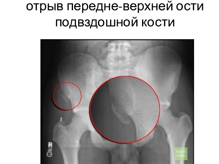 отрыв передне-верхней ости подвздошной кости