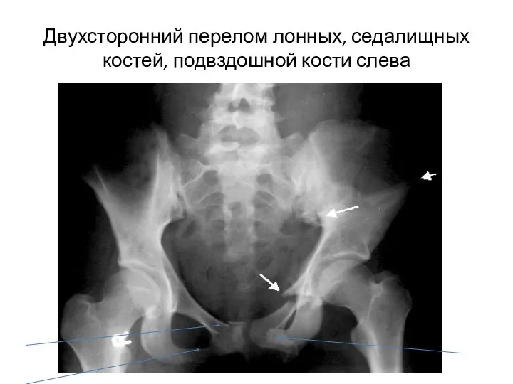 Двухсторонний перелом лонных, седалищных костей, подвздошной кости слева