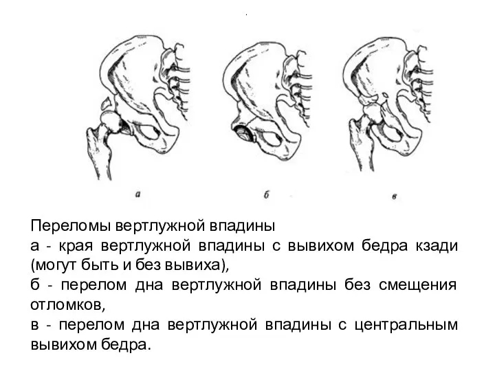 . Переломы вертлужной впадины а - края вертлужной впадины с вывихом