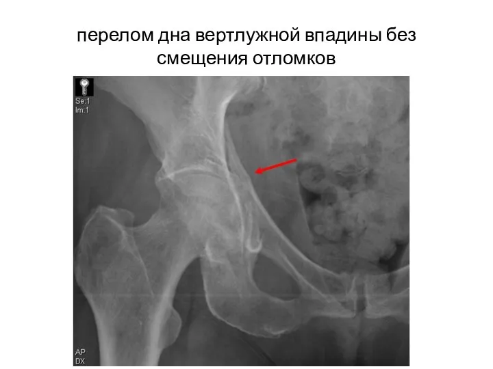 перелом дна вертлужной впадины без смещения отломков