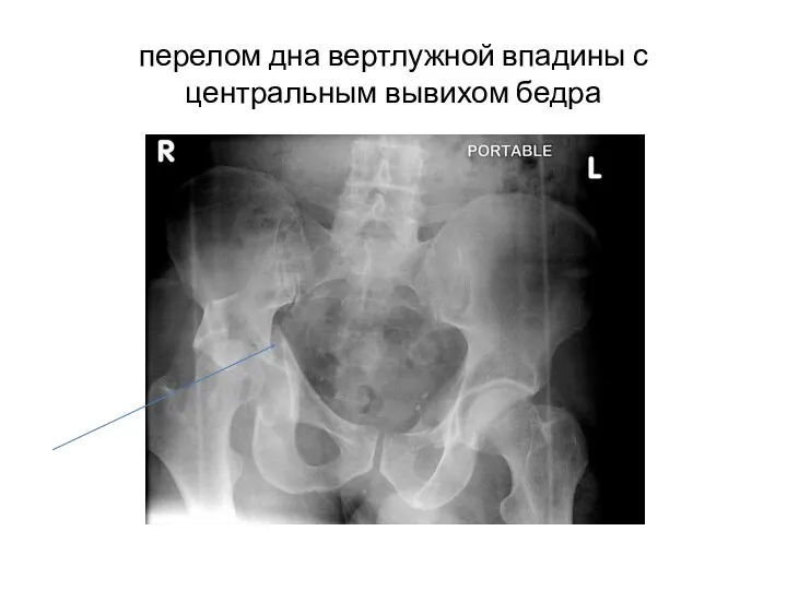 перелом дна вертлужной впадины с центральным вывихом бедра