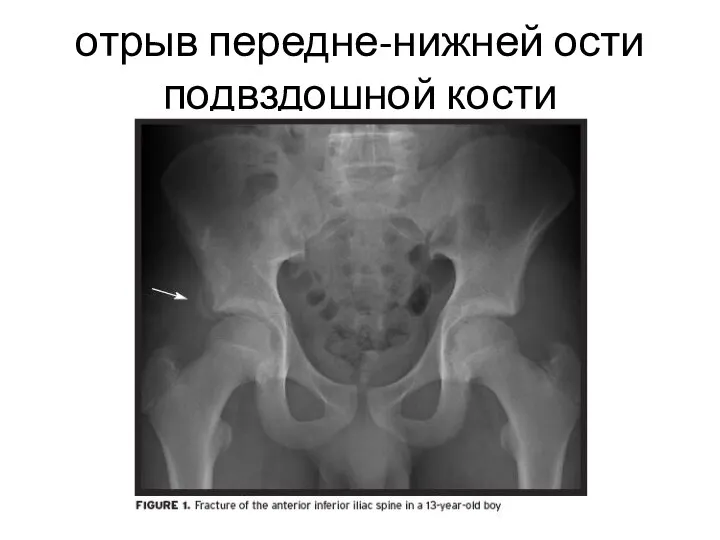 отрыв передне-нижней ости подвздошной кости