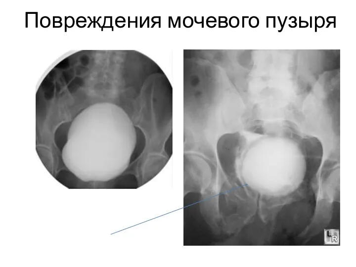 Повреждения мочевого пузыря