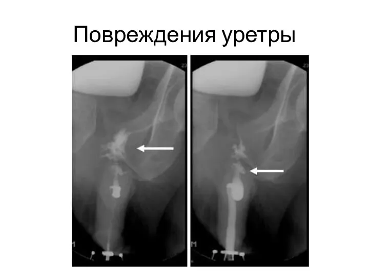 Повреждения уретры