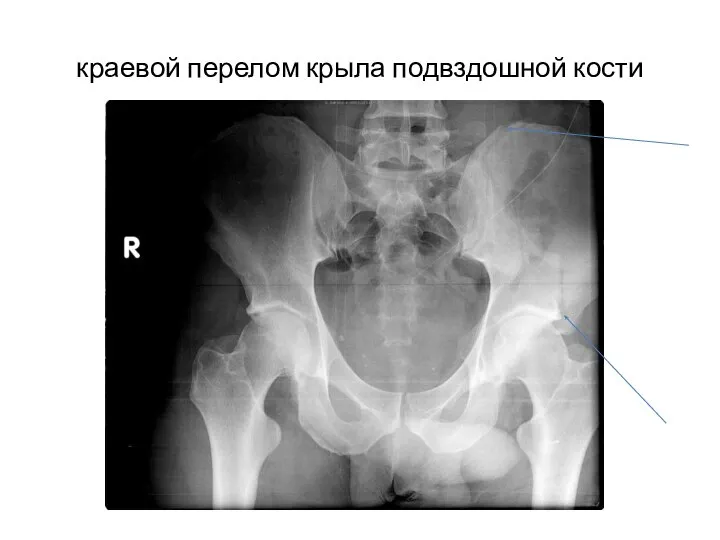 краевой перелом крыла подвздошной кости