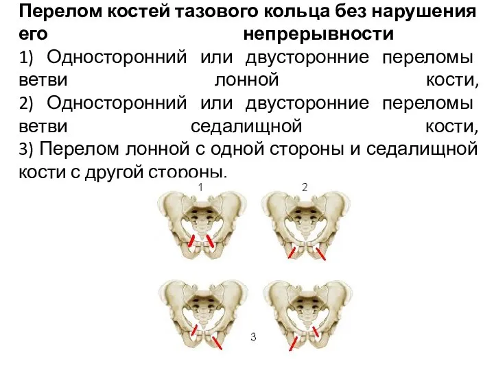 Перелом костей тазового кольца без нарушения его непрерывности 1) Односторонний или