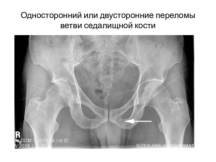 Односторонний или двусторонние переломы ветви седалищной кости