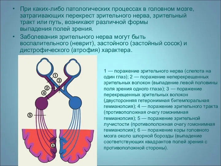 При каких-либо патологических процессах в головном мозге, затрагивающих перекрест зрительного нерва,