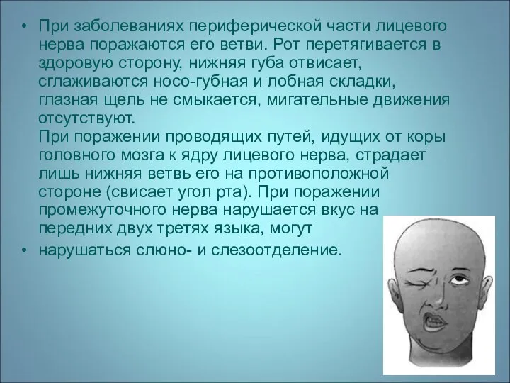 При заболеваниях периферической части лицевого нерва поражаются его ветви. Рот перетягивается