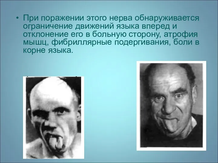 При поражении этого нерва обнаруживается ограничение движений языка вперед и отклонение