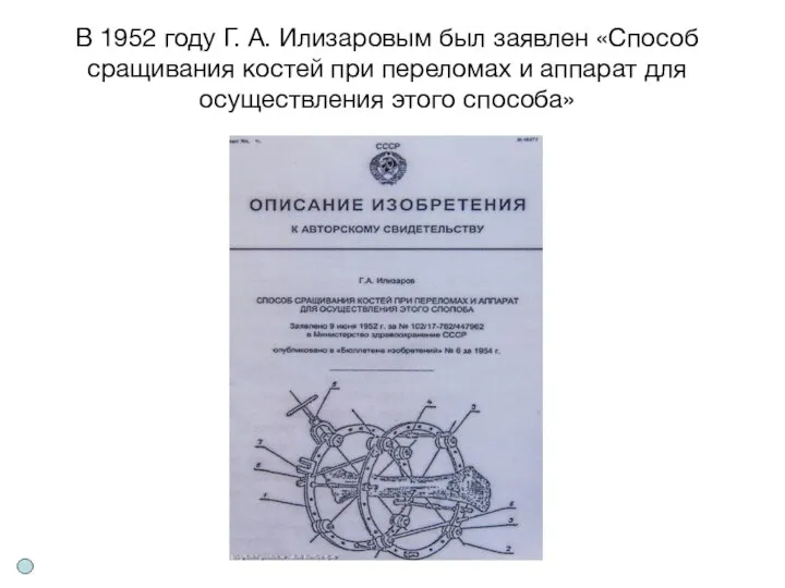 В 1952 году Г. А. Илизаровым был заявлен «Способ сращивания костей