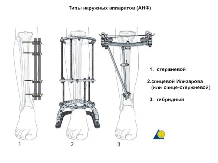 Типы наружных аппаратов (АНФ) стержневой спицевой Илизарова (или спице-стержневой) гибридный