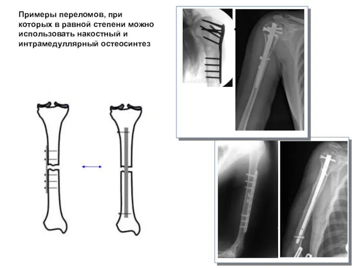Примеры переломов, при которых в равной степени можно использовать накостный и интрамедуллярный остеосинтез